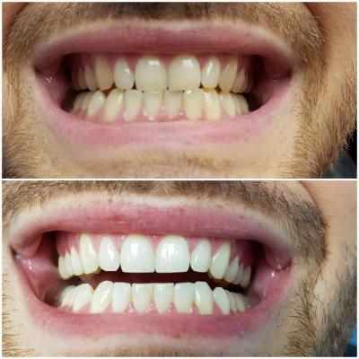 Blanchiment dentaire produit français